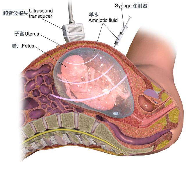 羊水/脐血穿刺