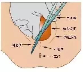 什么情况下要选择侧切