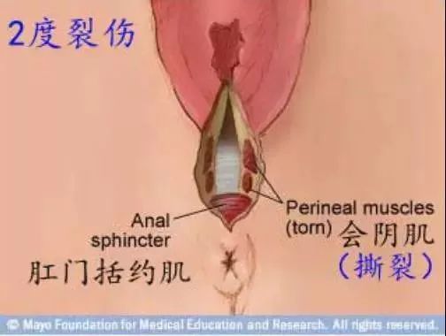 10个顺产8个撕裂