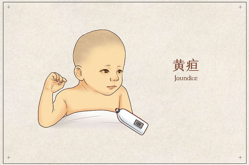 新生儿的黄疸问题
