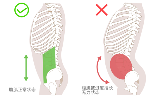 骨盆前倾