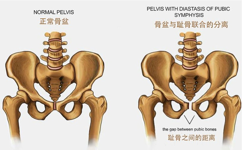 耻骨联合分离疼痛